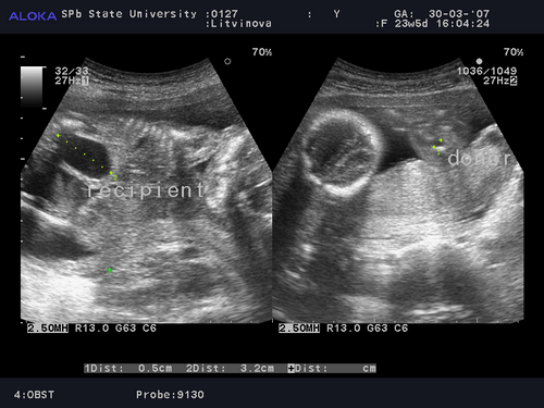 Фето-фетальный трансфузионный синдром при сроке беременности 23 нед